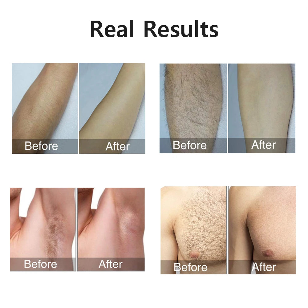 Advanced Portable IPL Laser Hair Removal Device - 999,999 Flashes for Pain-Free and Lasting Hair Elimination for Women's Body and Bikini Areas